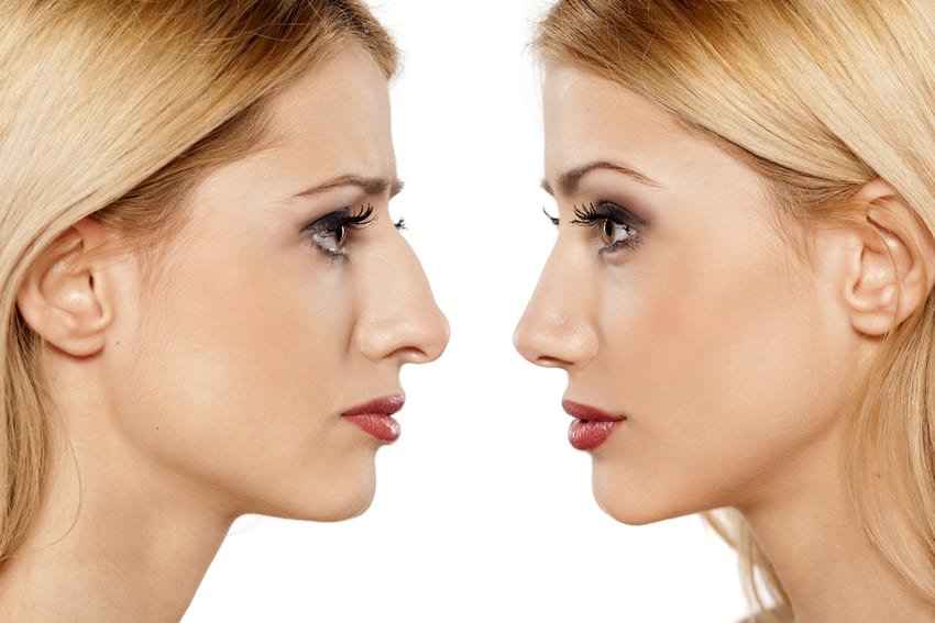 Rhinoplastika Turecko : Ceny v Istanbule a kompletný sprievodca